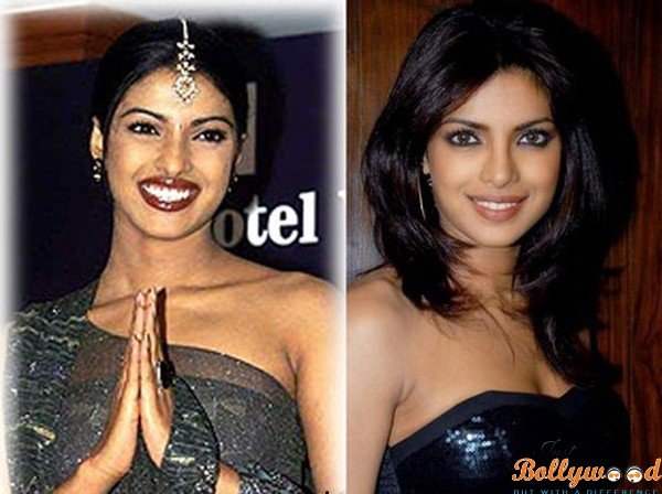 priyanka chopra plastic surgery before and after